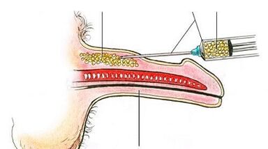 Surgical method of increasing member