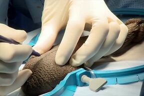 Midge incision for expansion of surgical penis